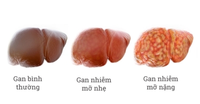 Gan nhiễm mỡ là gì, dấu hiệu nhận biết tình trạng gan nhiễm mỡ