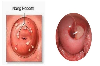 Đốt nang Naboth cổ tử cung là gì? Khi nào nên thực hiện?