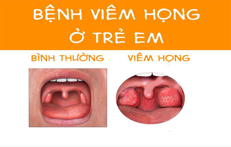 Viêm họng ở trẻ 1 tuổi: Nguyên nhân, Triệu chứng và Cách Điều Trị Hiệu Quả