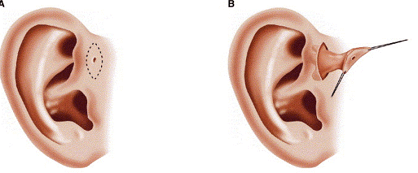 Những thực phẩm phù hợp sau phẫu thuật rò luân nhĩ 