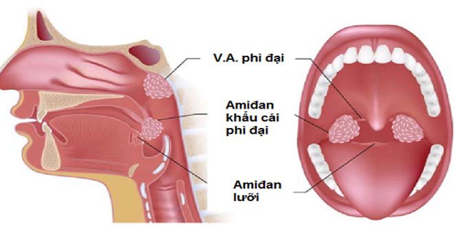 Các biến chứng và lưu ý sau nạo VA