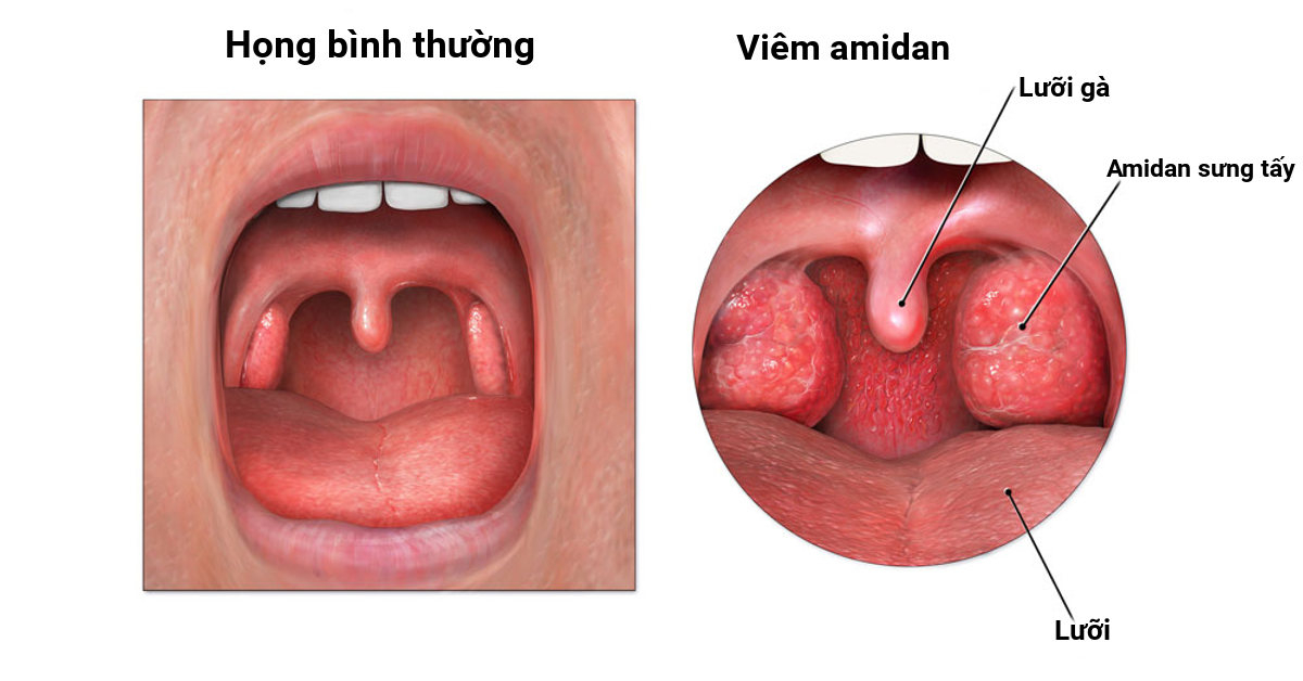 Viêm Amidan Tiếng Trung Là Gì? Giải Đáp Chi Tiết Và Cách Điều Trị Hiệu Quả