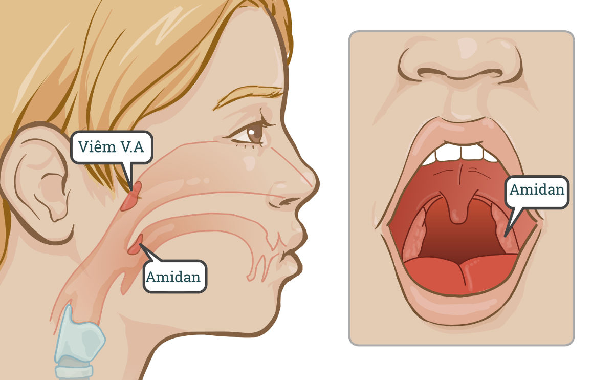 Viêm VA Có Tự Khỏi Không? Triệu Chứng, Nguyên Nhân và Cách Điều Trị Hiệu Quả