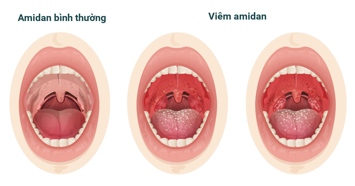 Các biện pháp phòng ngừa viêm amidan