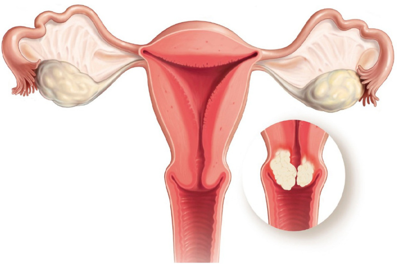 Các Câu Hỏi Thường Gặp Về Nang Xơ Tử Cung