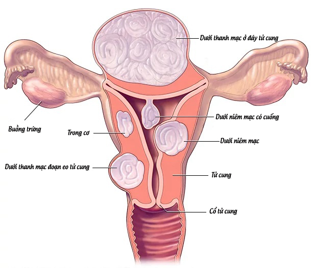 4. Sau Điều Trị U Nang Tử Cung, Phụ Nữ Có Thể Mang Thai Không?