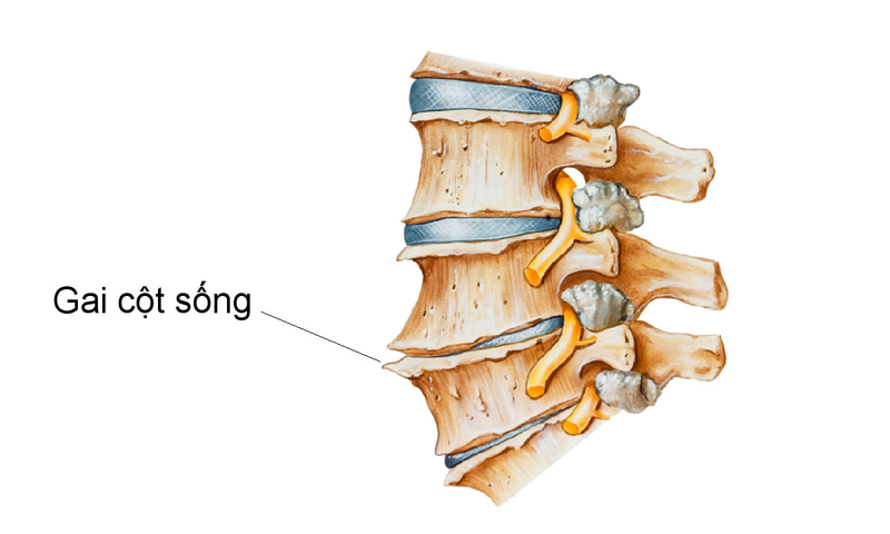 Bài Mẫu 9: Những Lưu Ý Khi Điều Trị Gai Cột Sống