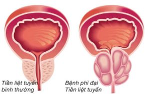 Treatment of Prostate Enlargement