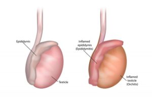 Orchitis Treatment
