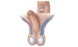 Varicocele Treatment