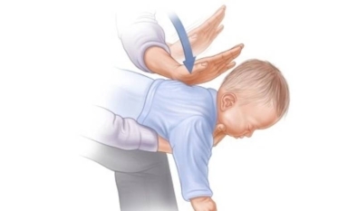 Hóc dị vật đường thở: Những điều cần biết