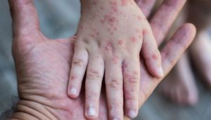 Khuyến cáo của Bộ Y tế về phòng chống bệnh sởi với nhóm có nguy cơ cao diễn biến nặng