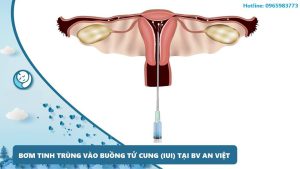 IUI – BƠM TINH TRÙNG VÀO BUỒNG TỬ CUNG- HIỆU QUẢ – AN TOÀN – CHI PHÍ THẤP