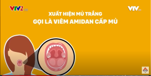 Nguyên nhân gây amidan cấp mủ