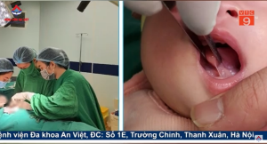 Phát hiện dính thắng lưỡi và các biện pháp can thiệp