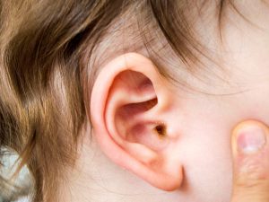 Causes of otitis media
