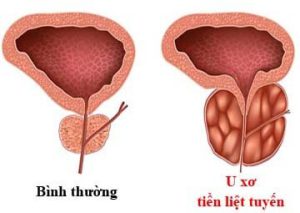 Symptoms and treatment of prostate cancer