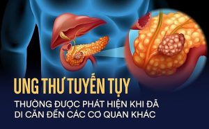 Ung thư tụy vì sao lại đứng đầu danh sách nguy hiểm