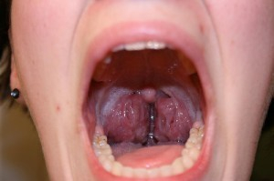 Bệnh viêm họng hạt uống thuốc gì và những vấn đề liên quan