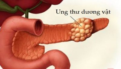 Bốn thủ phạm gây ung thư ‘Cậu nhỏ”