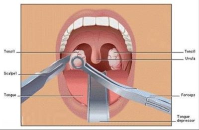 Cách chữa viêm amidan hiệu quả nhất hiện nay