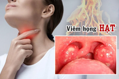 Bệnh viêm họng hạt có nguy hiểm không và những lưu ý để điều trị dứt điểm?