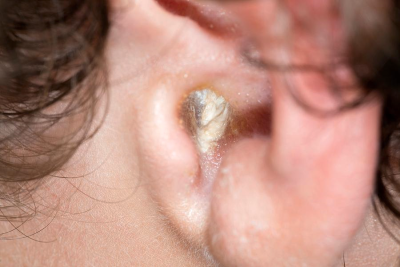 Bệnh viêm tai ngoài có những biến chứng nguy hiểm gì?