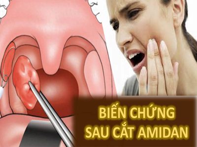 Biến chứng sau cắt amidan có thể gặp phải là gì?