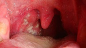 Cắt amidan có nguy hiểm không? Chuyên gia giải đáp