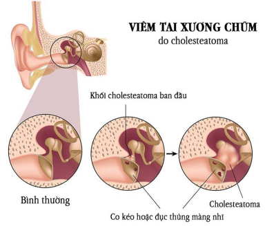 CHI PHÍ MỔ VIÊM TAI XƯƠNG CHŨM BAO NHIÊU TIỀN?