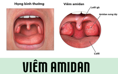 Chuyên gia tư vấn viêm amidan hốc mủ bao lâu thì khỏi?