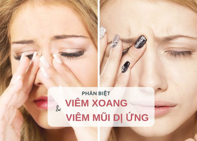 Làm sao phân biệt viêm xoang và viêm mũi dị ứng?