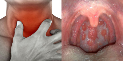 Lý do khiến bệnh viêm họng hạt kéo dài dai dẳng