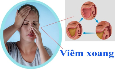 Nguyên nhân, triệu chứng của viêm xoang