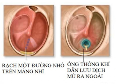 NHỮNG ĐIỀU CẦN BIẾT VỀ CHỈ ĐỊNH ĐẶT ỐNG THÔNG KHÍ MÀNG NHĨ