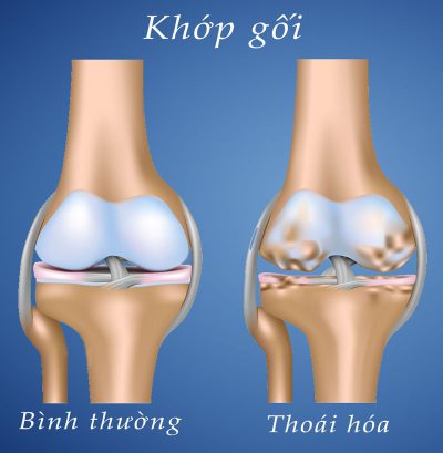 Chữa thoái hóa khớp bằng liệu pháp huyết tương giàu tiểu cầu ở Việt Nam