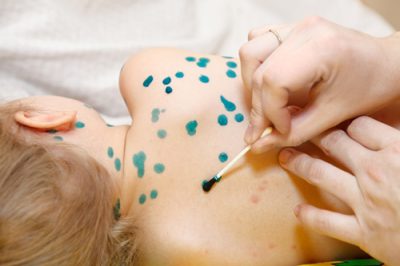 The best way to care for a child with chickenpox