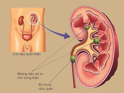 Sỏi tiết niệu có nguy hiểm không?