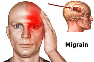 Migraine headaches are common but many people take them lightly