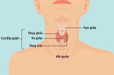 7 cách phòng bệnh ung thư tuyến giáp hiệu quả