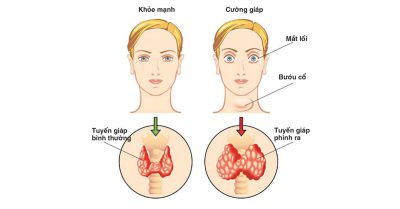 Những loại thực phẩm người bị cường giáp không nên ăn