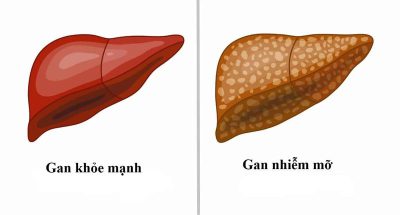 Những dấu hiệu của bệnh gan nhiễm mỡ