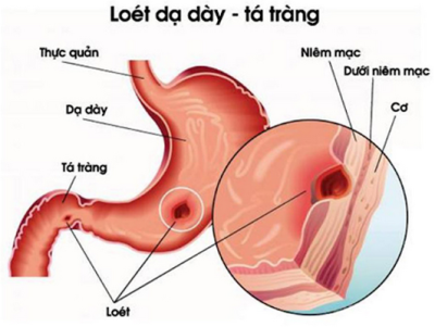 Những nguyên nhân gây thoái hóa niêm mạc dạ dày