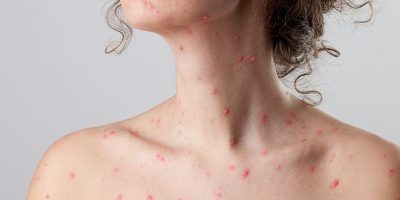 Bệnh thủy đậu: Triệu chứng và biến chứng nguy hiểm