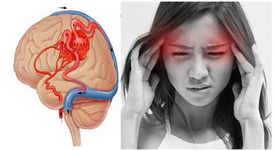 Dị dạng mạch máu não có triệu chứng gì, nguy hiểm không?