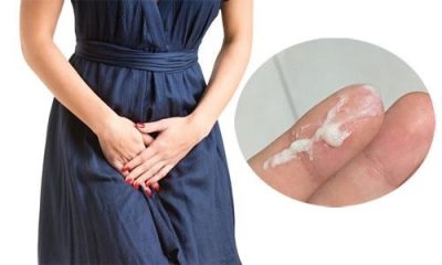 Vùng kín có cặn trắng là dấu hiệu bệnh gì