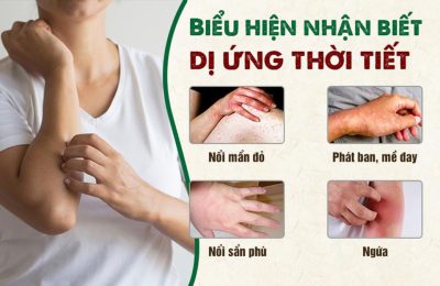 Dị ứng thời tiết: Nỗi ám ảnh của nhiều người là bệnh gì?