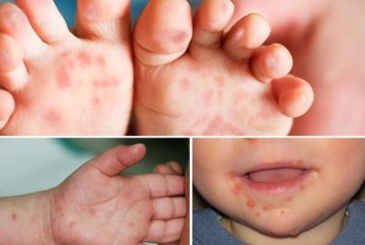 Chuyên gia cảnh báo trẻ bị tay chân miệng có dấu hiệu sau cần nhập viện ngay