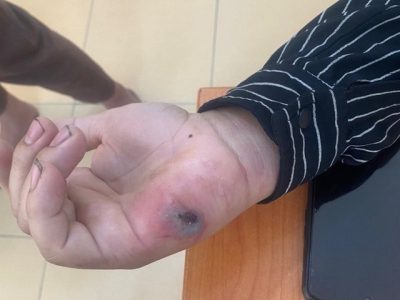 Bệnh than là bệnh gì, có triệu chứng thế nào?