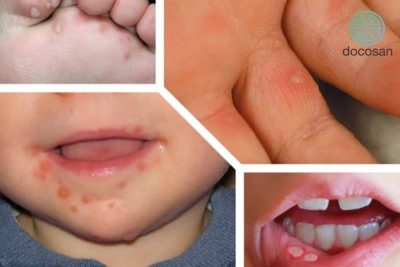 Những biến chứng nguy hiểm của bệnh tay chân miệng